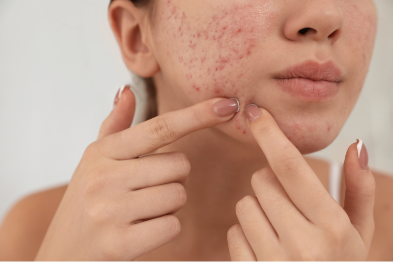 Types of Acne