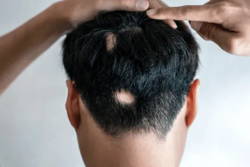Alopecia Areata Treatment