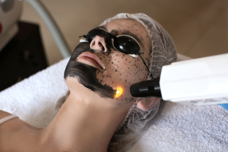 Carbon Laser Facial Treatment