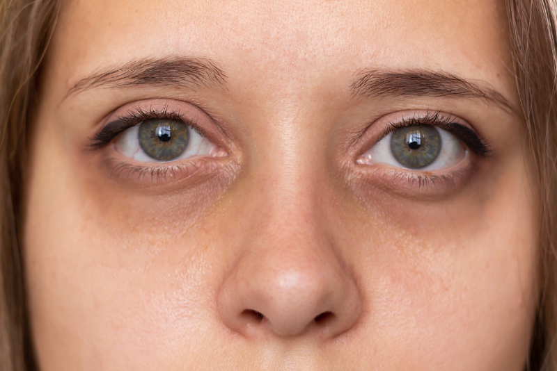 Dark Circles Treatment