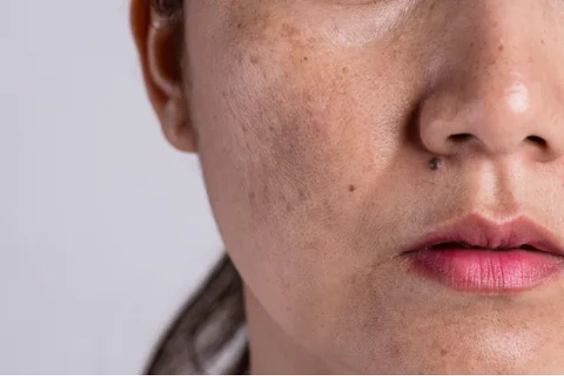 Hyperpigmentation Treatment