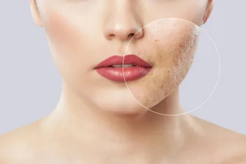 Laser for Acne Scar Treatment