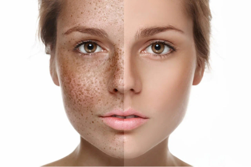 Laser for Freckles & Age Spots Treatment