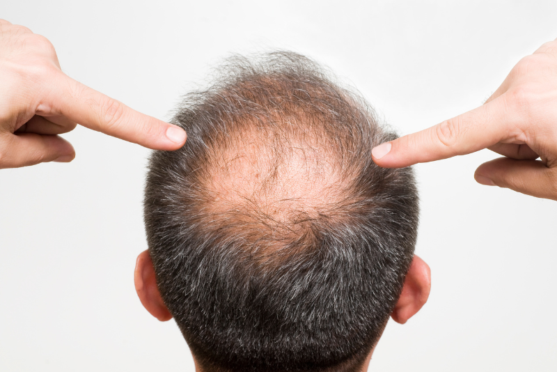 Male/Female Pattern Baldness Treatment