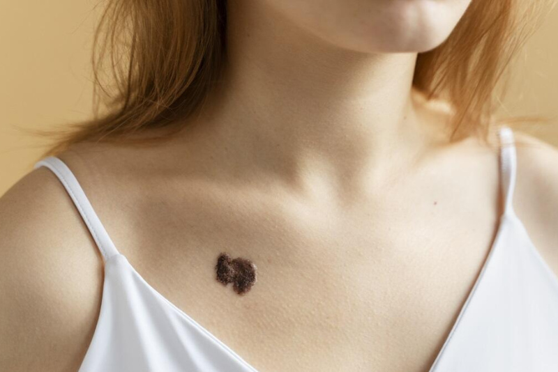Mole, Wart & Skin Tag Removal Treatment