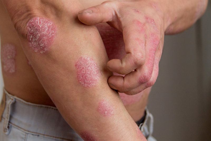 Psoriasis Treatment