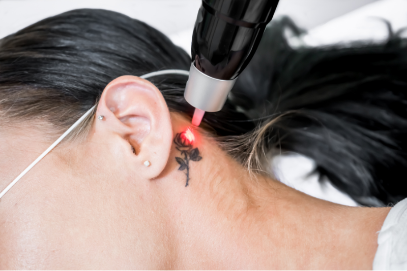 Tattoo Removal Treatment