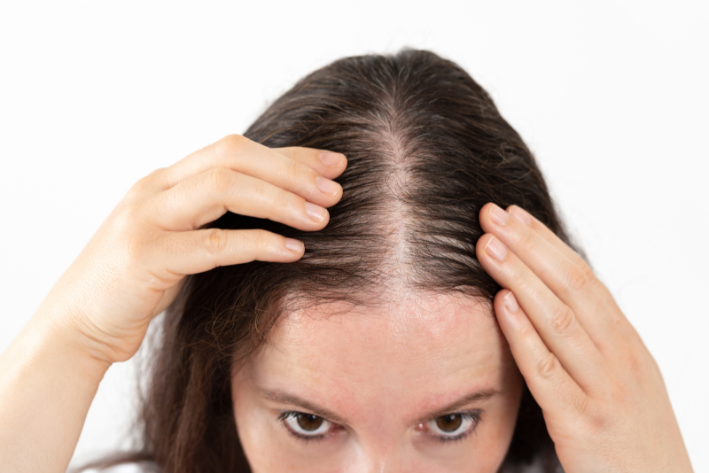 Thinning Hair Treatment