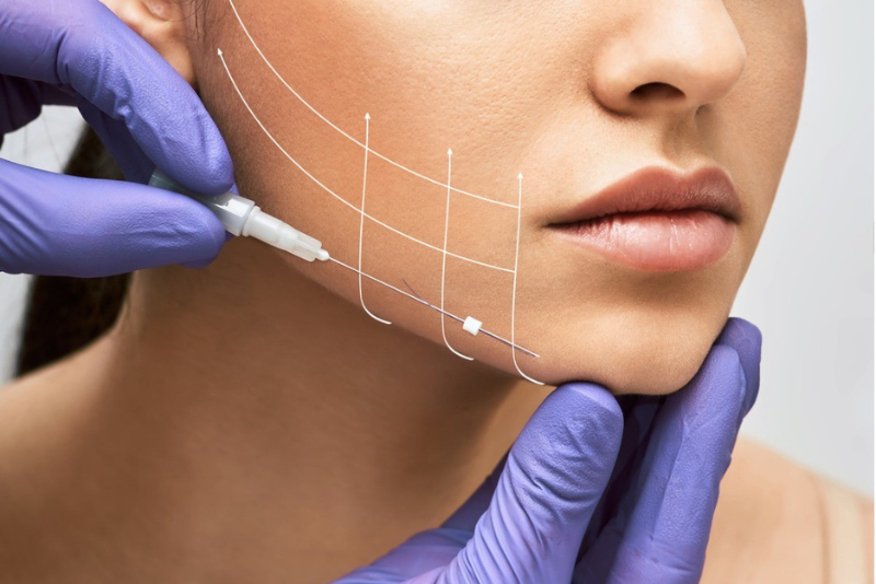 Thread Lift Treatment