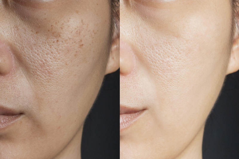 Chemical Peels Treatment