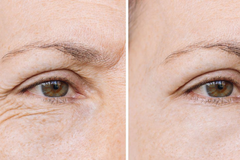 Fine Lines & Wrinkles Treatment